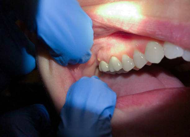 Best Cracked Tooth Emergency Dentist  in Chatmoss, VA